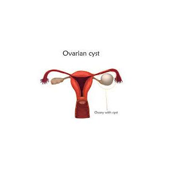 Ovarian cyst treatment powder